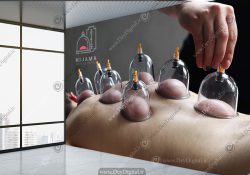 پوستر سه بعدی بادکش درمانی
