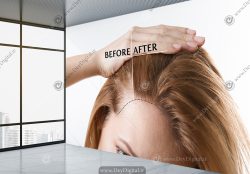 پوستر دیواری سه بعدی کلینیک کاشت مو