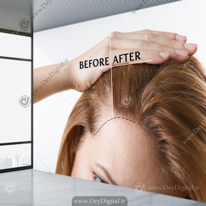 پوستر دیواری سه بعدی کلینیک کاشت مو